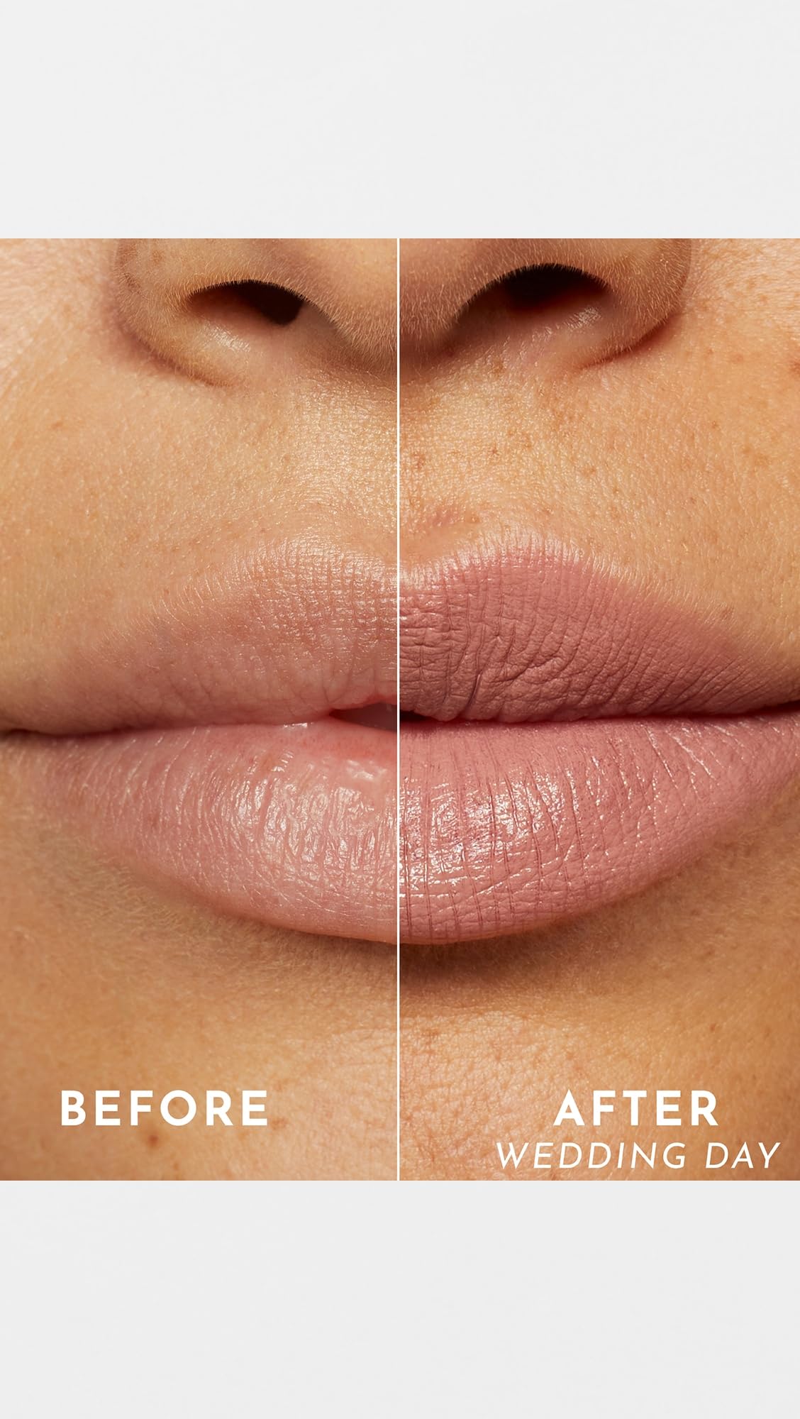 Lawless before-and-after lips showing visible smoothing and subtle plumping