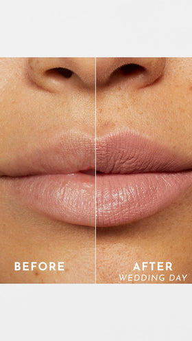Lawless before-and-after lips showing visible smoothing and subtle plumping