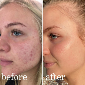 lissy skincare label close-up listing mandelic acid, niacinamide, licorice, hyaluronic benefits