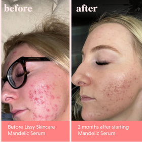 lissy skincare serum droplet on finger showing lightweight consistency and easy absorption