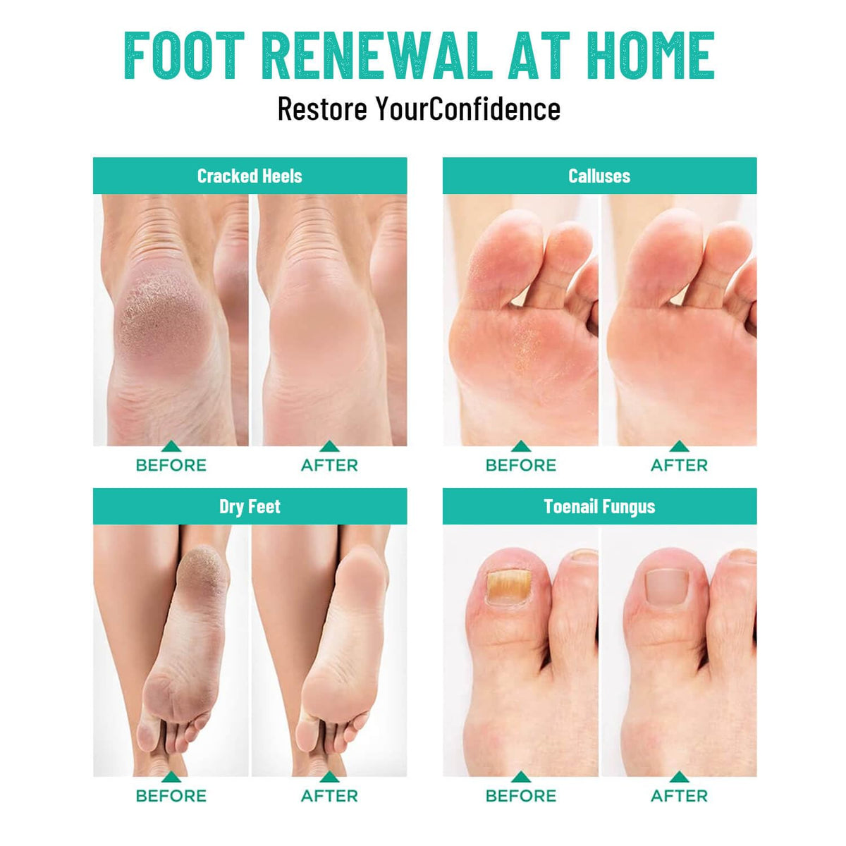 LUIFAC callus before after illustrating softened skin results