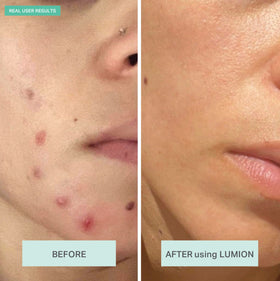 LUMION skin label close-up highlighting stabilized HOCl and mineral blend benefit