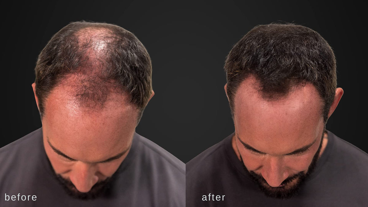 LUXE before and after part comparison showing reduced scalp visibility