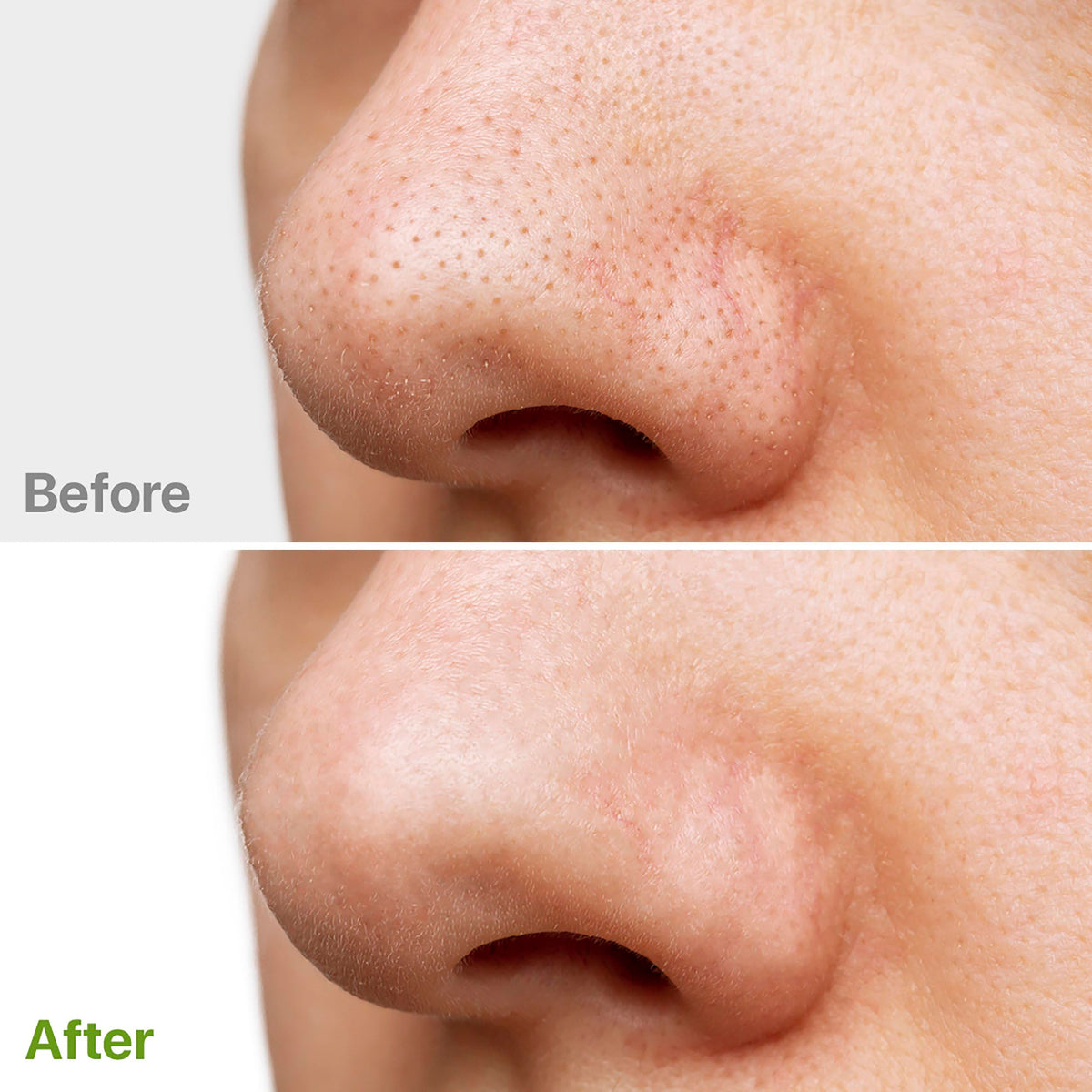 M-REDI pad used on neck and décolletage showing extended body exfoliation benefits