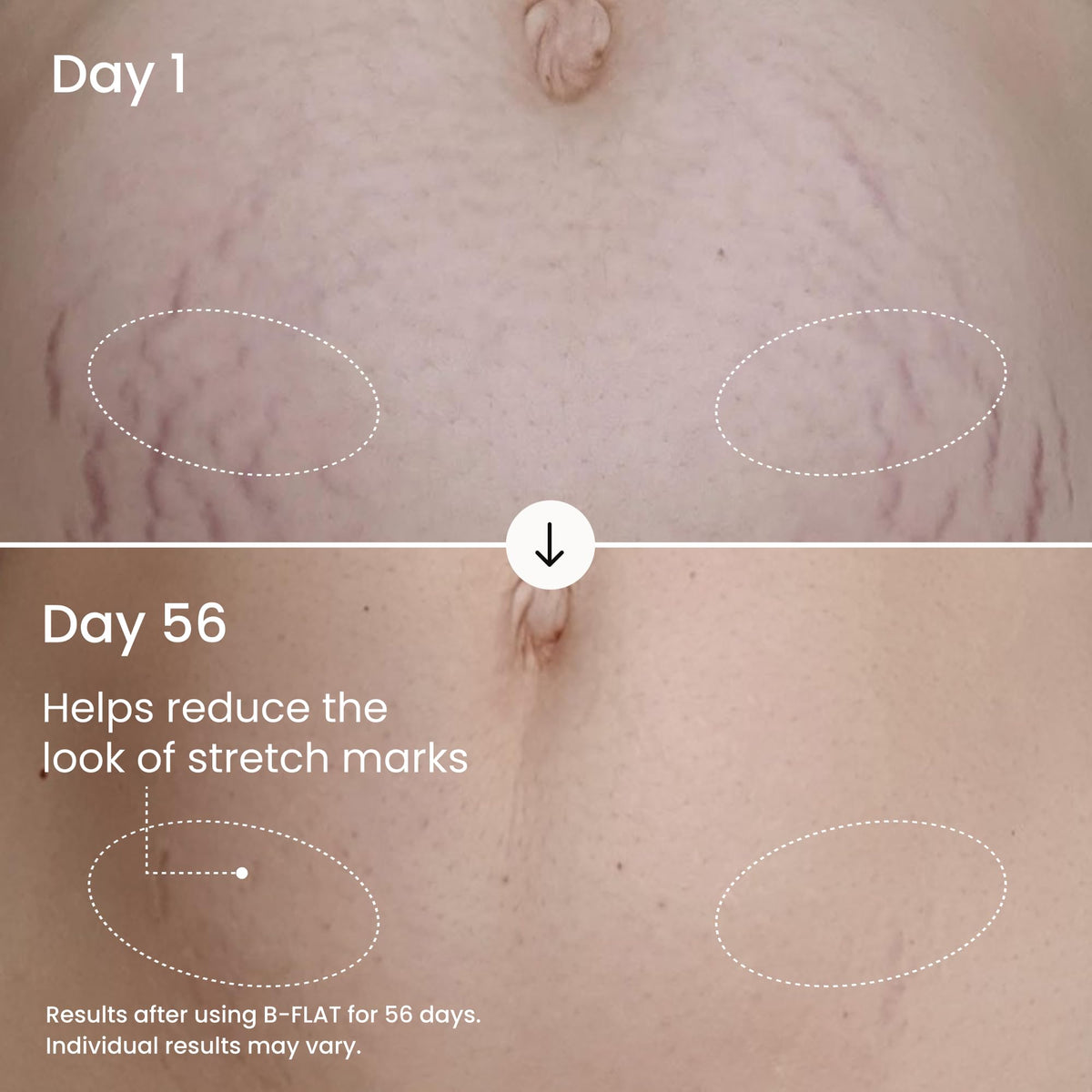 MAËLYS applied to belly demonstrating targeted firming benefit