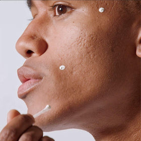 MALIN+GOETZ applied to blemish with cotton swab demonstrating targeted overnight treatment
