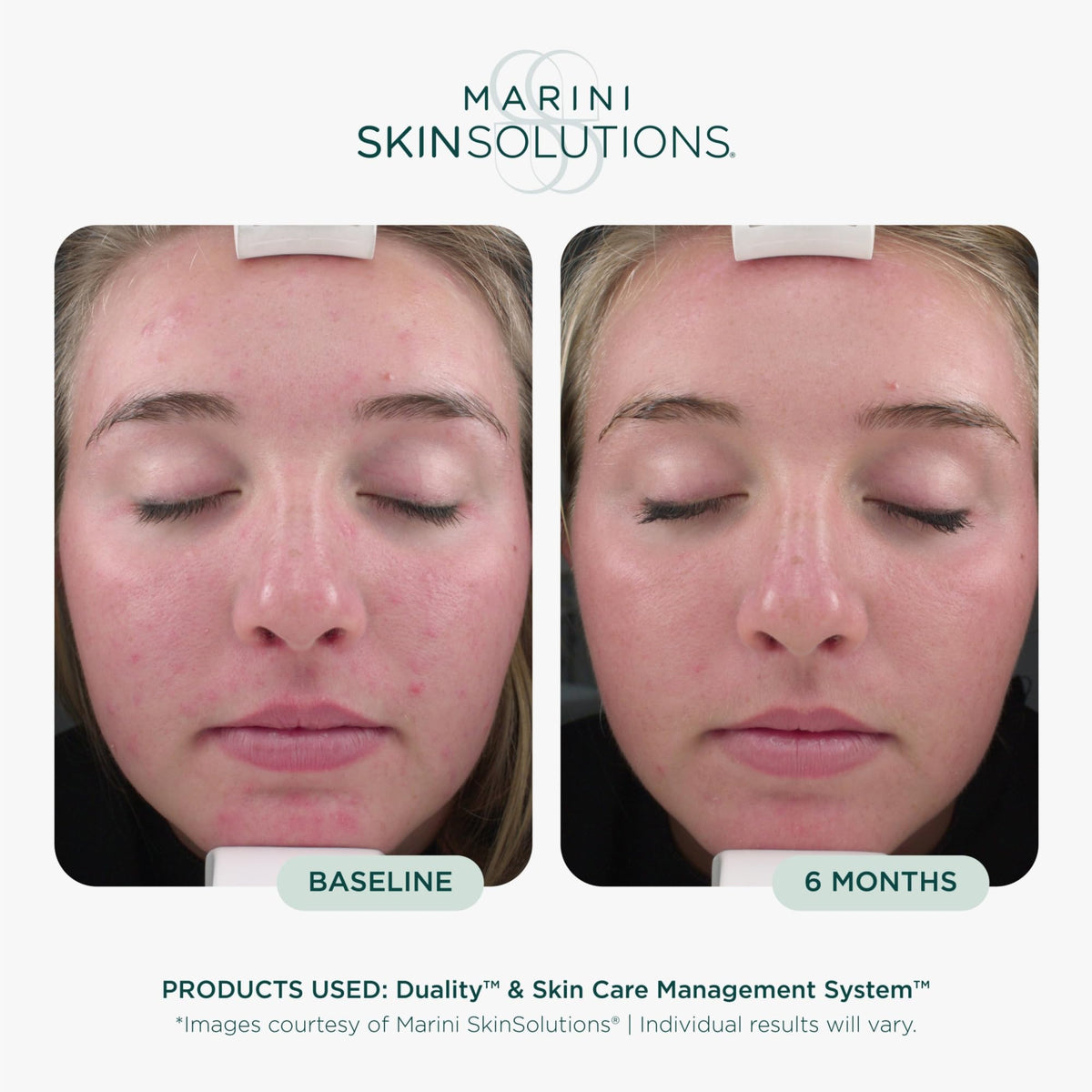 Marini SkinSolutions cream texture close-up showing smooth emulsion for blemish control and smoothing