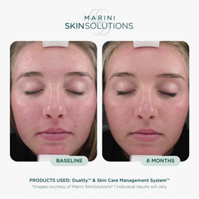 Marini SkinSolutions cream texture close-up showing smooth emulsion for blemish control and smoothing