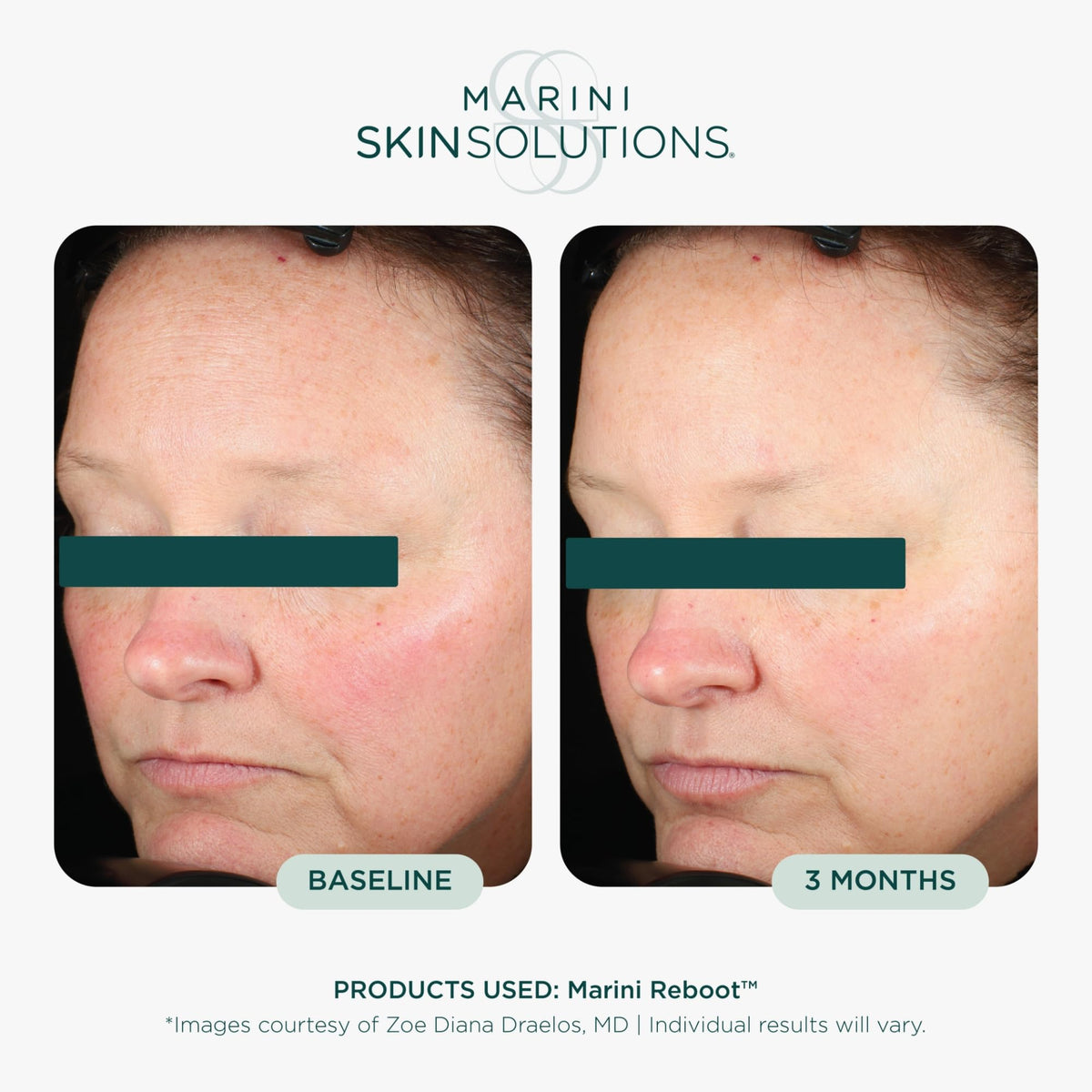 Marini SkinSolutions pump dispenser detail for controlled, hygienic dosing