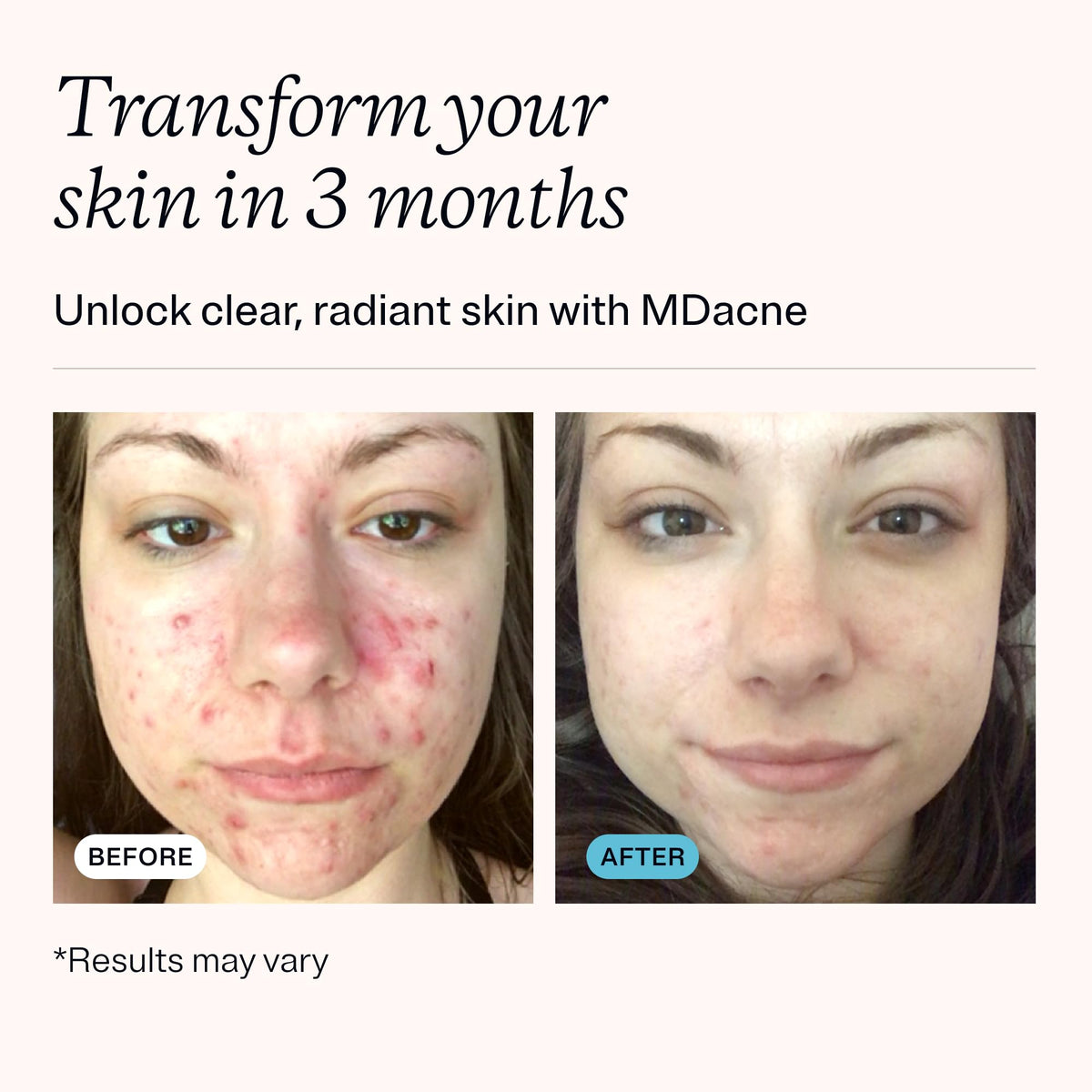 MDacne cream on fingertip demonstrating easy application and targeted coverage