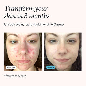 MDacne cream on fingertip demonstrating easy application and targeted coverage