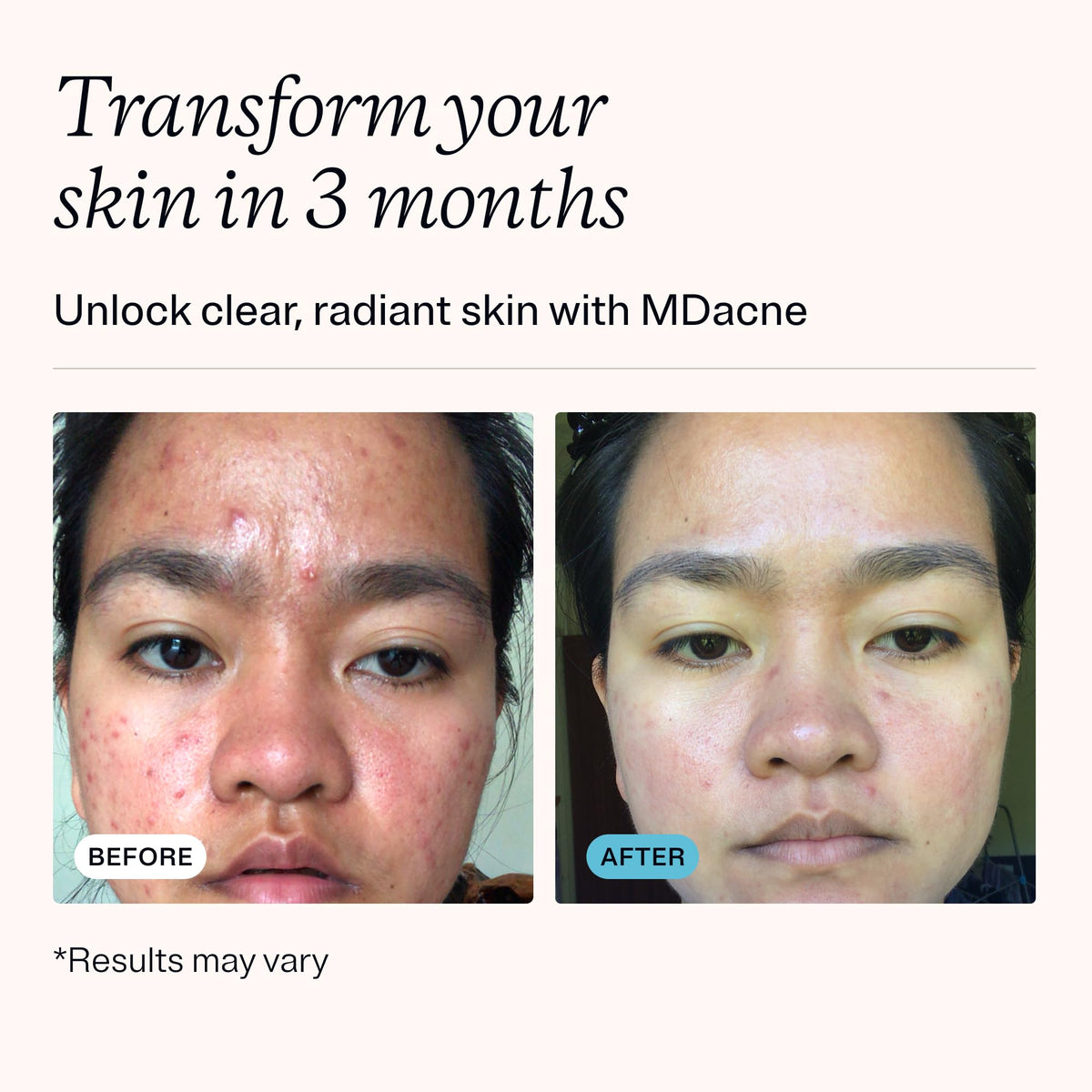 MDacne benzoyl peroxide 2.5% treatment tube detail highlighting targeted blemish control