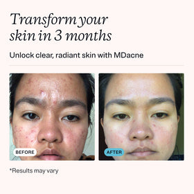 MDacne cream on fingertip demonstrating easy application and targeted spot treatment benefit