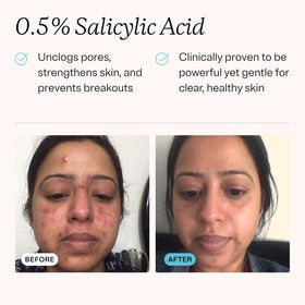 MDacne dispensing pump releasing cleanser to show controlled, low-waste application