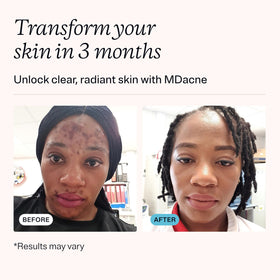 MDacne salicylic cleanser pump closeup demonstrating easy, non-drying cleanse