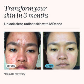 MDacne salicylic acid cleanser pump detail highlighting gentle pore-clearing action