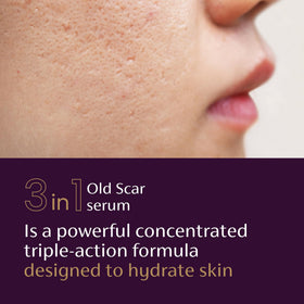 Mederma size shown in hand illustrating 1 fl oz travel-friendly volume and portability
