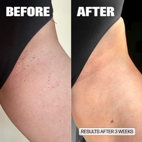 Medicine Mama's before and after bikini area showing reduced bumps and smoother result benefit