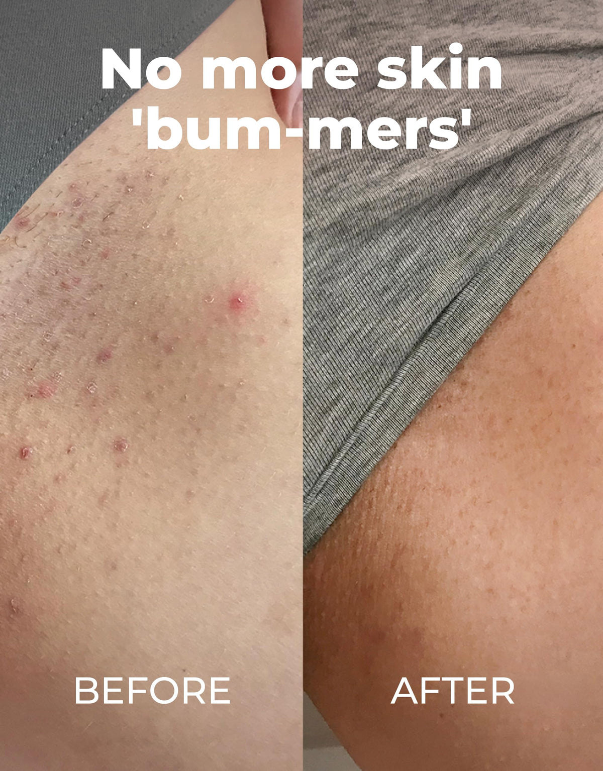 Applying Miami Beach Bum to leg to soothe razor bumps and moisturize skin