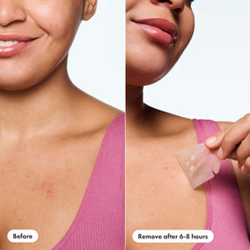 Mighty Patch adhesive texture macro illustrating medical-grade hydrocolloid