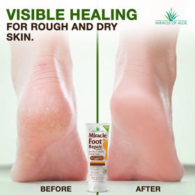 Miracle of Aloe applying cream to heel demonstrating softening benefit