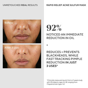 Model applying Murad mask to face showing targeted blemish coverage benefit