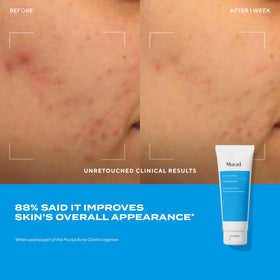 Murad spot treatment tube cap view highlighting targeted blemish control benefit