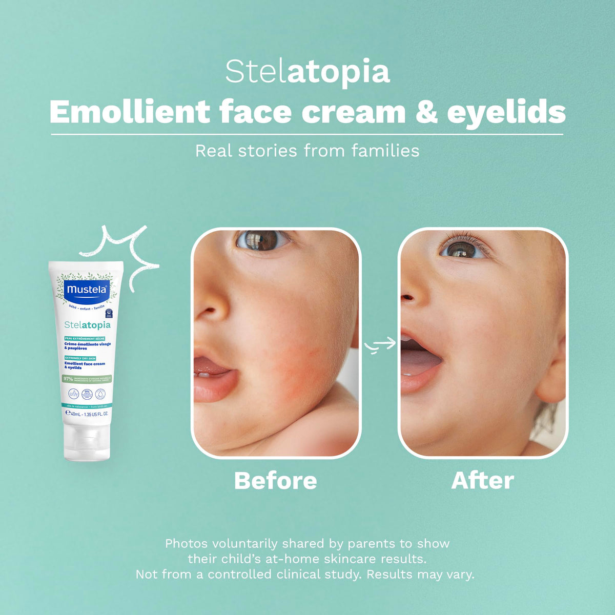 Mustela Stelatopia being gently applied to a baby cheek for soothing