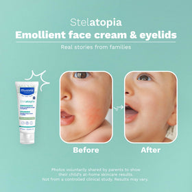 Mustela Stelatopia being gently applied to a baby cheek for soothing