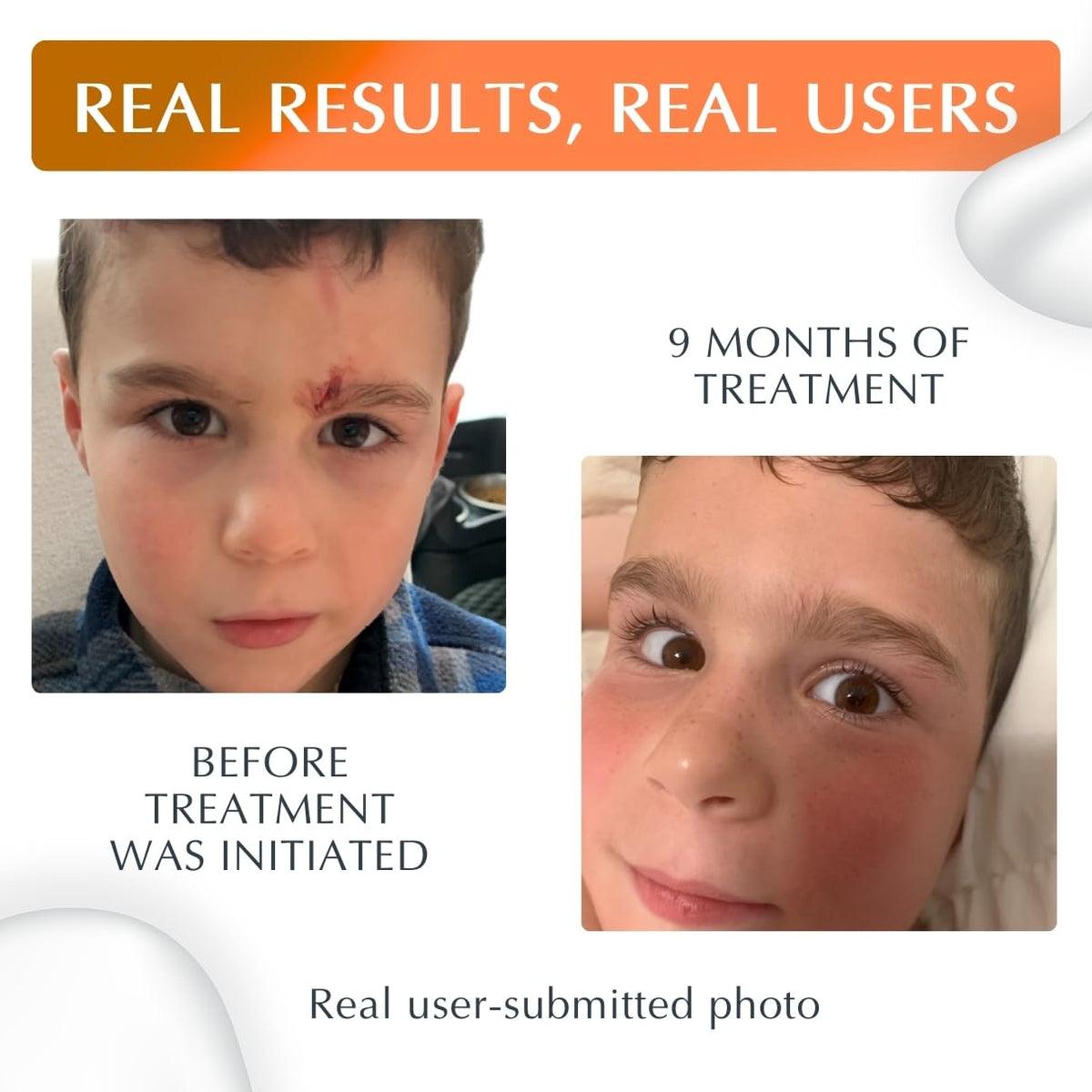 MyNewGel plus being applied to hand scar demonstrating protective barrier benefit
