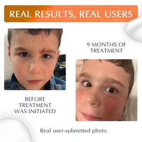 MyNewGel plus being applied to hand scar demonstrating protective barrier benefit