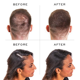 Before and after comparison with Nanogen fibers showing visible fullness benefit