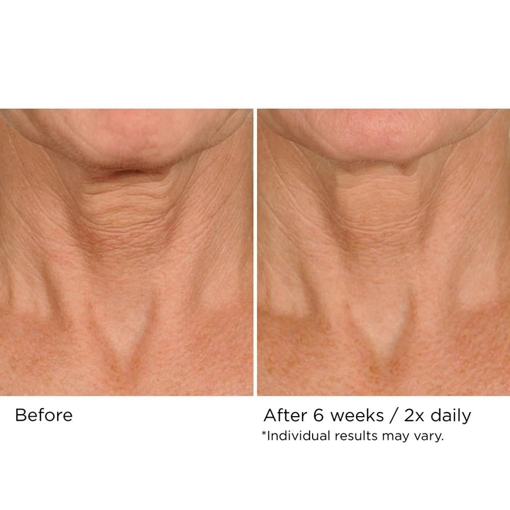 NASSIFMD product being applied to neck demonstrating targeted use