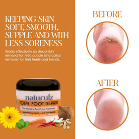 Naturulz being applied to a cracked heel demonstrating targeted relief