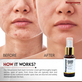 Neoprosone being applied to a facial dark spot, demonstrates precise spot-correcting benefit