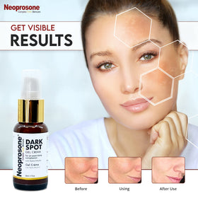 Neoprosone cream on fingertip ready to apply, illustrates easy targeted application