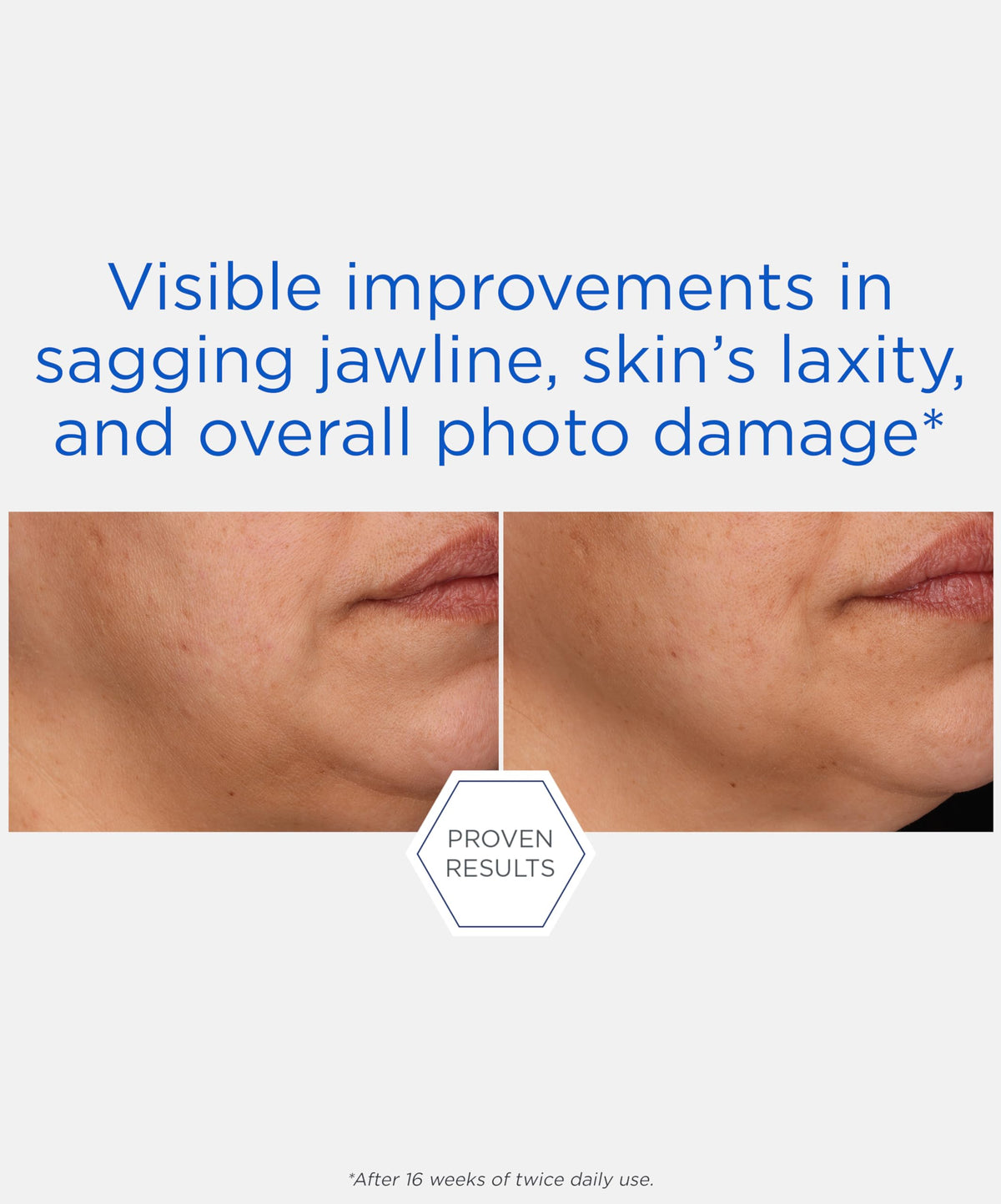 NEOSTRATA before-and-after schematic illustrating improved contour and texture