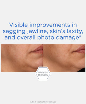 NEOSTRATA before-and-after schematic illustrating improved contour and texture