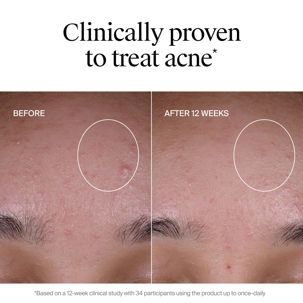 Neutrogena before and after comparison highlighting improved clarity and even tone