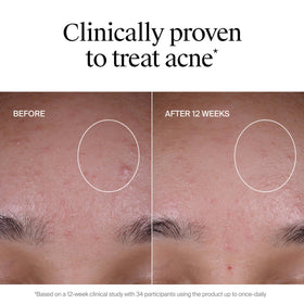 Neutrogena before and after comparison highlighting improved clarity and even tone