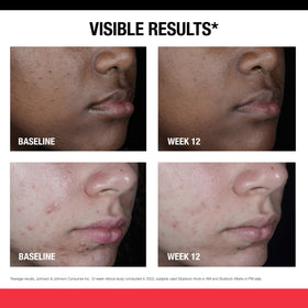 Neutrogena retinol SA label view highlighting key ingredients and benefits