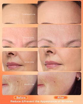 NEWKEY mask worn by model demonstrating comfortable fit and skin-improvement benefit