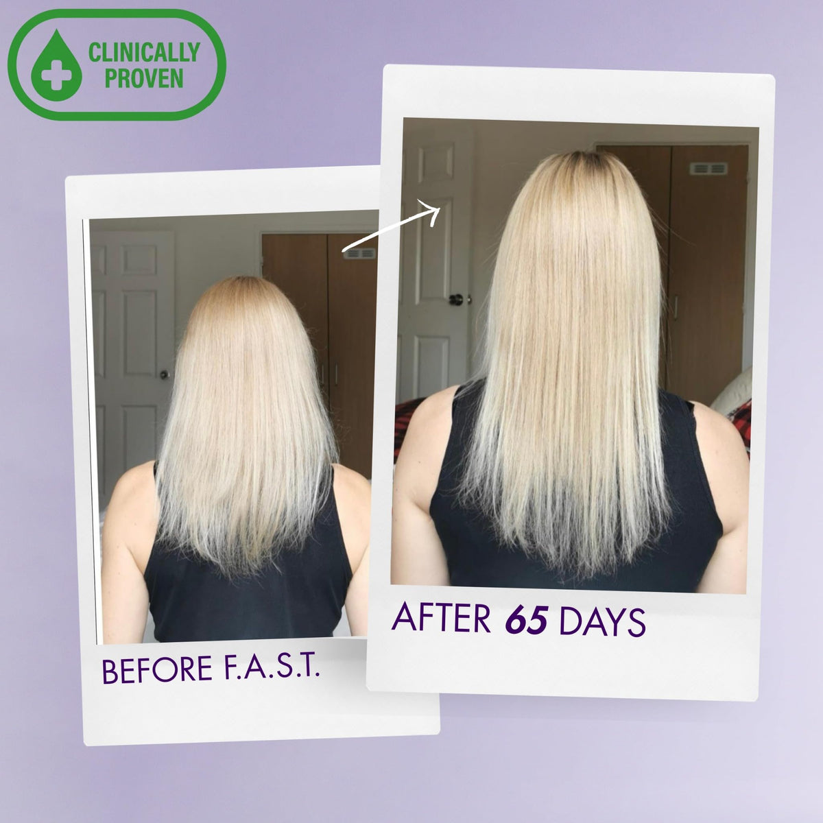 Nisim before after scale illustration comparing visible fullness improvement