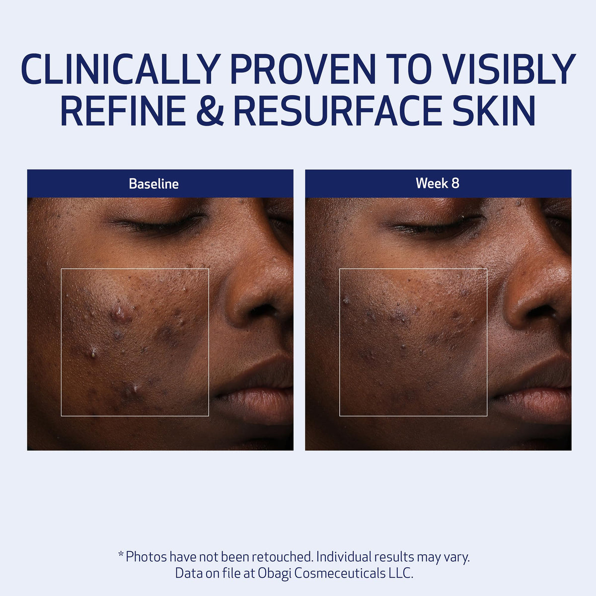 Obagi Medical before-and-after skin texture comparison showing improvement
