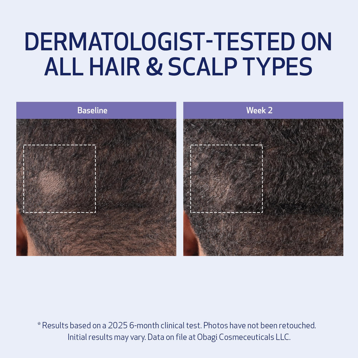 Obagi Nu-Cil application parting hair to target the scalp for even distribution