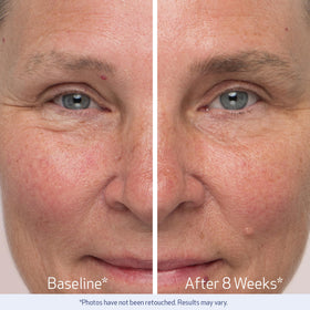 Obagi Medical Nu-Cil conceptual before and after to show improved fill