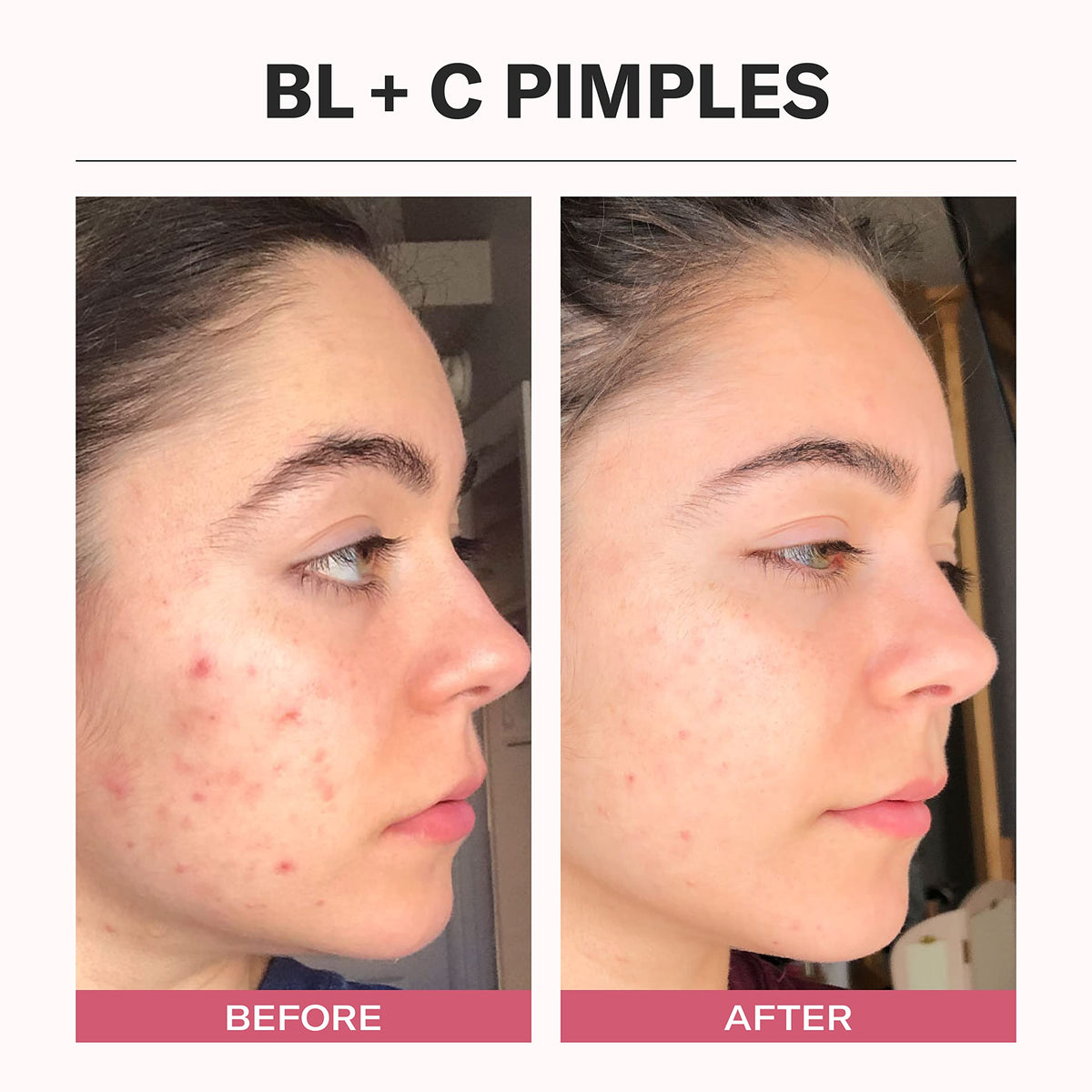 Odacité BL+C applied to cheek illustrating targeted pore-clearing use