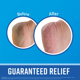Before and after hands using O'Keeffe's showing improved skin smoothness after two weeks