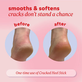 Onyx Professional balm applied to cracked heel illustrating targeted softening and protection