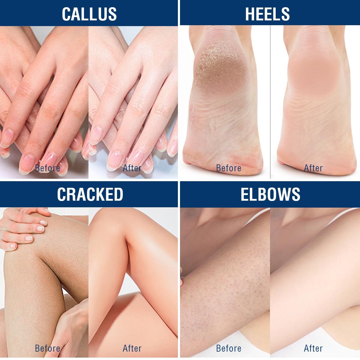 OUKEYA cream applied to heels demonstrating targeted relief for rough skin